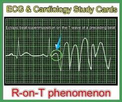 Ecg Cardiology Study Cards R On T Phenomenon Nursing Study Guide Cardiology Study Cardiology
