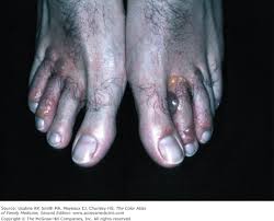 Image result for Tinnea vesiculosa