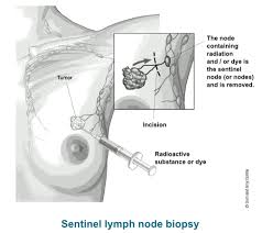 Breast Cancer In Lymph Nodes Lymph Node Surgery For Breast Cancer