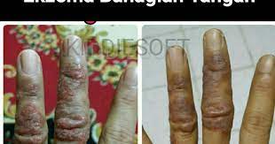(tiada gambar untuk dipaparkan) purified herb dapat menghilangkan. Ubat Kudis Buta Secara Tradisional Rawatan 2