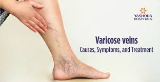 We did not find results for: Varicose Veins Causes Symptoms Treatment Diagnosis And Prevention