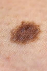 Is It Normal For A New Mole To Appear Causes And Warning Signs is it normal for a new mole to appear