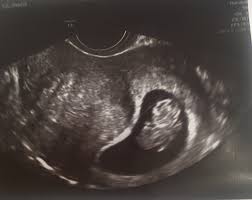 Check spelling or type a new query. First Ultrasound Today August 2019 Babies Forums What To Expect