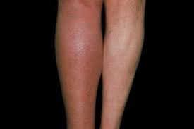 A clot blocks blood circulation through these veins, which carry blood from the lower body back to the heart. Blood Clots Nhs