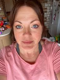 Would love some advice. I have had some under eye injections (redensity 1)  and have some swelling under my eye. It looks like they could bruise a bit.  I start a new