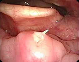 Fish Bones In The Throat Ent Clinic