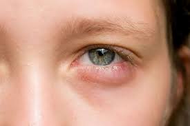 Use a cotton ball to apply the witch hazel to the areas under the eyes for five minutes. Puffy Eyes Causes And Treatment Area Oftalmologica Avanzada