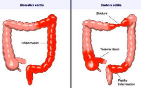 crohns disease vs ulcerative colitis ibd medchrome