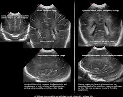 Pvl gold series domin8 (40 serving) svn price $39.99. Preterm White Matter Injury Ultrasound Diagnosis And Classification Pediatric Research