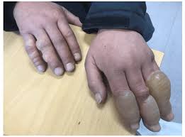 Image result for Frostbite