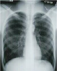 X Ray Atlas Chest X Ray Glowm