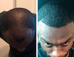 Surgical hair restoration — as performed by a true expert. Afro Hair Transplant Hair Growth Centre