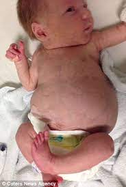 Baby With Swollen Stomach The Size Of A Football Makes Miraculous Recovery Despite Doctors Warning He May Not Even Be Born Alive Daily Mail Online