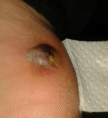 Sie treten bevorzugt an fingern, fußsohlen, im gesicht und genitalbereich auf und sind unangenehm für jeden, der sie hat. Dornwarzen Vereisen