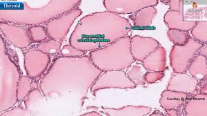 1)â graves disease is marked by hyperfunctioning of thyroid gland owing to stimulation by histology/gross pathology. Histology Of Thyroid Gland Shotgun Histology Youtube