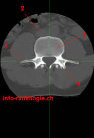 La particularité des fractures de la septième vertèbre lombaire (l7) est double. Anatomie Rachis Lombaire