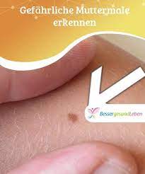 gefahrliche muttermale erkennen besser gesund leben muttermal leberfleck besser gesund leben