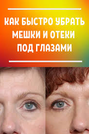 как в домашних условиях убрать темные круги под глазами Eto Super Produkt Za 15 Minut Ischezayut Meshki I Temnye Krugi Pod Glazami V 2020 G Temnye Krugi Pod Glazami Krugi Pod Glazami Lico
