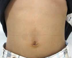 It can get better on its own as a child grows up and his/her muscles become more strong. Operative Procedures Of Single Incision Laparoscopic Repair Of Pediatric Epigastric Hernia Have Become Simple And Feasible With The Use Of A Novel Suture Assisting Needle Sciencedirect