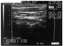 Doctors may also do tests to learn which treatments could work best. Ultrasonography Of The Thyroid Endotext Ncbi Bookshelf