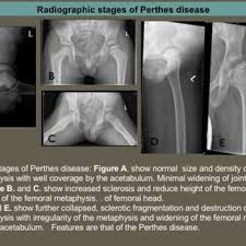 Characteristic ultrastructural appearance of the glomerular intramembranous minimal change disease. Pdf Role Of Imaging In A Limping Child Learning Objectives Role Of Imaging Plain Films Ultrasound Ct Mri And Bone Scintigraphy In Patients Presenting With Limping Radiological Findings Of Different Diseases Diagnosed