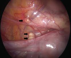 Do not copy paste type yourself word by word. Female Genital Tuberculosis Revisited Sharma Jb Sharma E Sharma S Dharmendra S Indian J Med Res