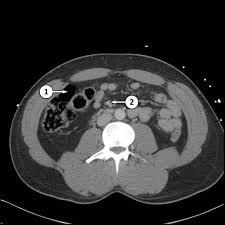 The pelvis is a symmetrical bony ring interposed between the vertebrae of the sacral spine and the lower limbs, which are articulated through complex joints, the hips. Ct Abdomen Pelvis Lower Axial Labeling Questions Radiology Case Radiopaedia Org