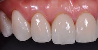 Tooth bonding is the process of applying a thin layer of composite resin the outer layer of the, often known as a typical tooth bonding veneer will last between 5 and 7 years before it needs replacing. How Long Do Veneers Last City Dental