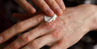 Neurodermitis Ursachen Symptome Behandlung Docfinder At