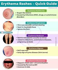 Image result for erythema nodosum