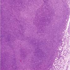 Check spelling or type a new query. Characteristic Suppurative Granulomas And Stellate Microabscess Download Scientific Diagram