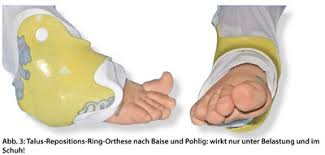 Sichelfüße kommen bei säuglingen häufiger vor. Fussfehlstellungen Beim Kind Hande Weg Von Einlagen Doctors Today