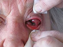 • because chronic gn usually causes only very mild or subtle symptoms, it goes undetected for a long time in most patients. Eye Neoplasm Wikipedia