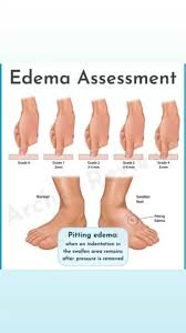 Image result for Edema Exam