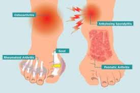 Cancer pain can affect your physical and mental state in many ways. Arthritis In Your Feet Causes Symptoms And Treatment