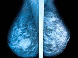What does lung cancer look like? Tomosynthesis Vs Other Screening Methods Benefits And Risks