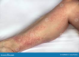 Image result for allergy rash on the legs