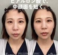 ヒアルロン酸注入直後。 顎を作り、チークに立体感を出すことで ...
