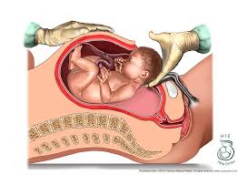 C Sections To Prevent Hypoxic Ischemic Encephalopathy Hie