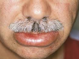 Angioedema Overview Altmeyers Encyclopedia Department Allergology