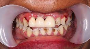 Maybe you would like to learn more about one of these? Loch Im Zahn Behandlung Ohne Schmerzen Centrocc Dental