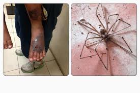 Esta araña vive en los estados unidos, y se la puede encontrar sobre todo en los estados situados en la parte central y en el sur. Alex Ar Twitter At N Saltillo Una Arana Violinista Provoca Esto Http T Co Kgd61s59ow