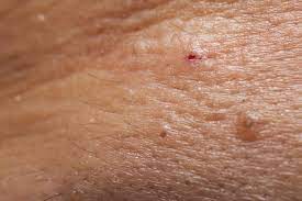 eingewachsene barthaare loswerden so geht s