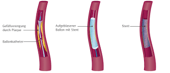 Verengung Der Halsschlagader Gefasschirurgie