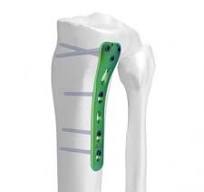 Pediatric Proximal Tibial Sliding Locking Plate,Medical ...