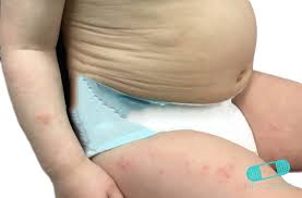 Image result for diaper dermatitis