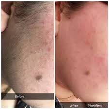 It lasers are useful for removing unwanted hair from the face, leg, chin, back, arm, underarm, bikini line sun exposure makes laser hair removal less effective and makes complications after treatment more likely. Before And After Facial Hair Safiah Laser Hair Removal Facebook