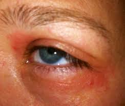 If the test is positive, a reaction will be seen at and around the place of injection or puncture. Allergie Symptome So Erkennst Du Eine Allergie
