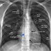 Hi doc, i want to ask what is the meaning of my chest xray result suspicious haziness on the upper right lobe. 1