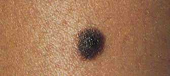 Most melanoma begins on the surface of the skin where it is usually easy to see and treat. How Black People Can Protect Their Skin From Cancer Our Weekly Black News And Entertainment Los Angeles